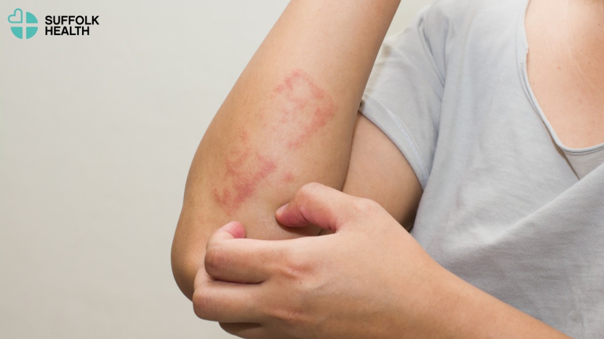 Understanding Allergies: Symptoms, Causes, and Treatments